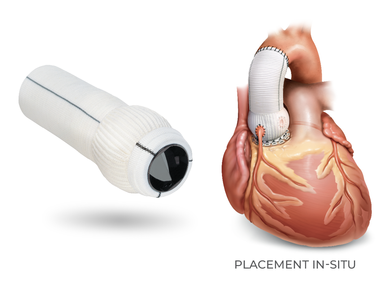 Produktbild - VF000184826 - Hjärtklaff aorta composite mekanisk, valsalva 27mm