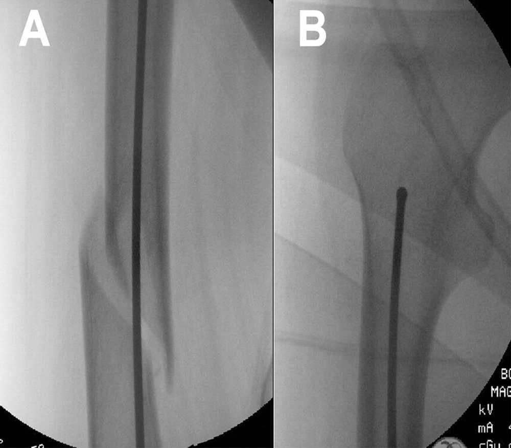 Produktbild - VF000190468 - Guide Wire, Ball-Tipped, sterile T2 Humerus Ø2.5x800 mm