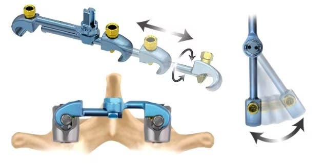 Produktbild - VF000173415 - End cap Prolock för ryggimplantat 5,5