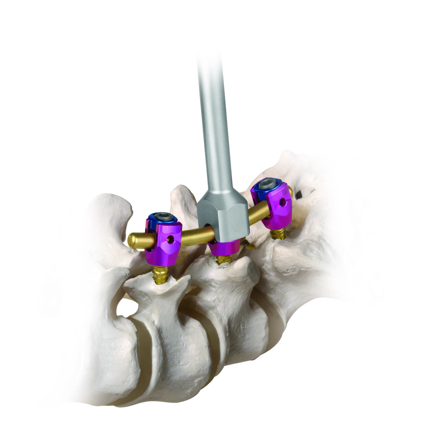 Produktbild - VF000169733 - Pedikelskruv för ryggimplantat polyaxial Revere 6.35 8,5mm längd 40mm