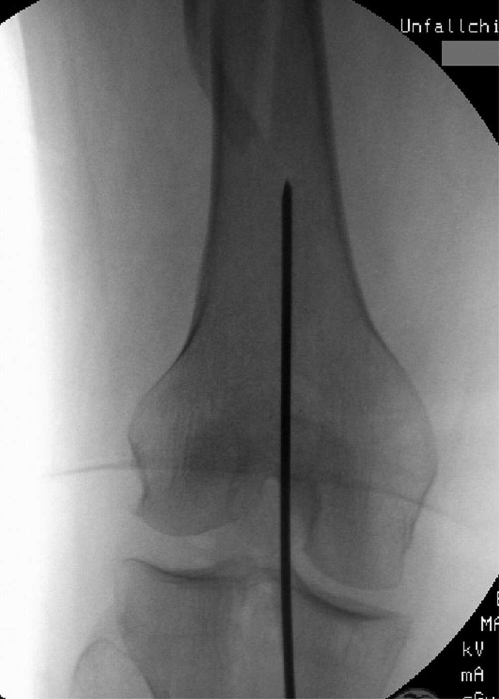 Produktbild - VF000190470 - Guide Wire, Smooth-Tipped, sterile T2 Humerus Ø2,2x800 mm