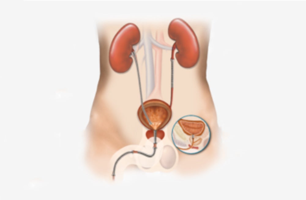 Produktbild - VF000160415 - Accesssystem för Memokath uretär nitinolstent antegrad