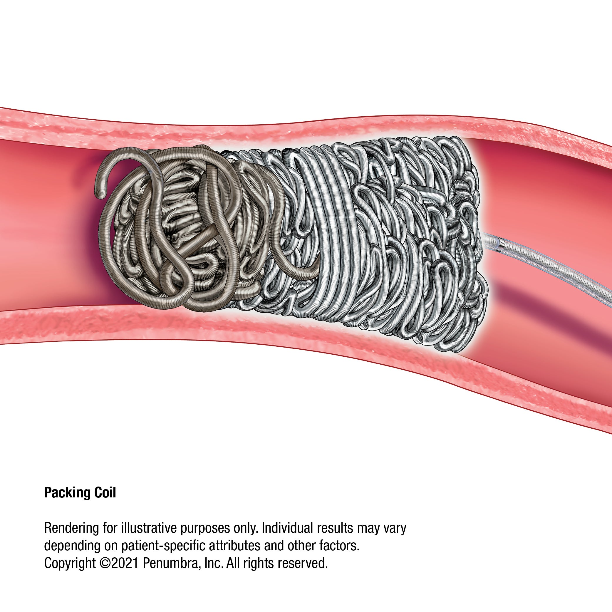 Produktbild - VF000161007 - Coil mikro avtagbar Ruby POD Packing 30cm