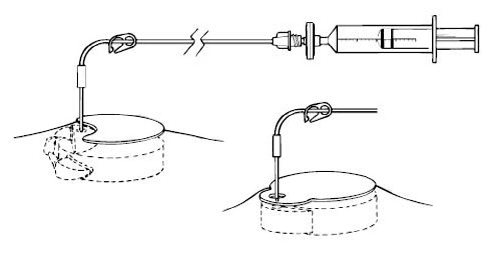 Produktbild - VF000119076 - 8540//KIT 8540 SYNCHROMED CATHETER-ACCESS PORT