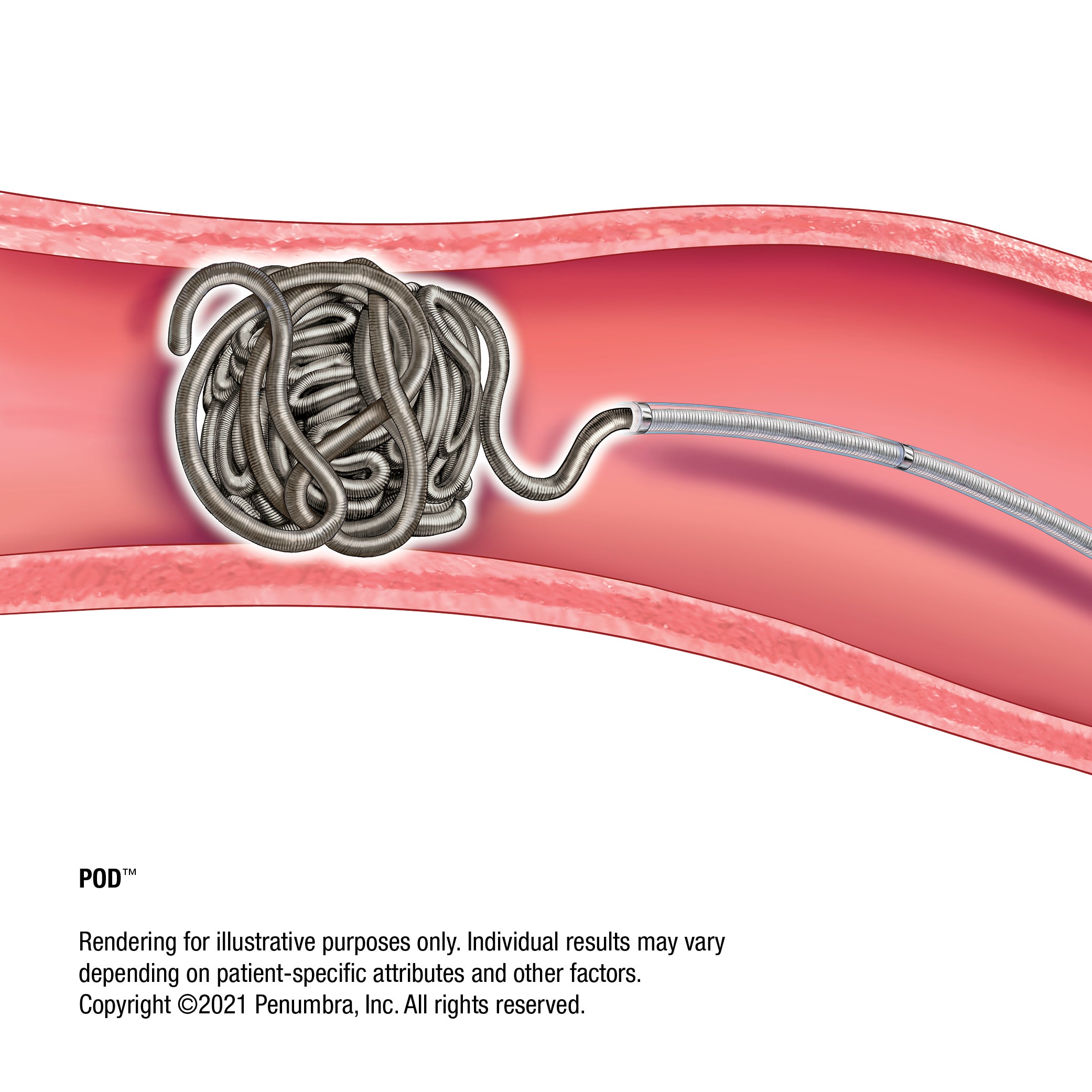 Produktbild - VF000161052 - Coil mikro avtagbar Ruby POD 10 10mmx60cm