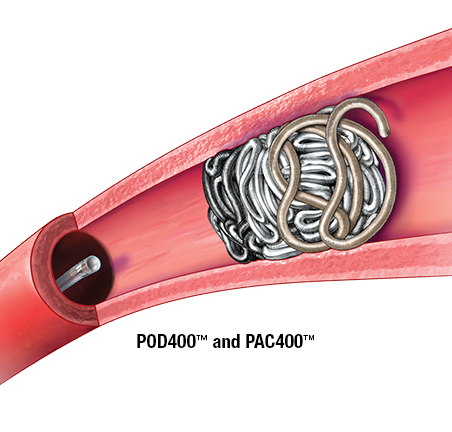 Produktbild - VF000164400 - Intrakraniell Coil POD Anchoring Platina 4mmx30cm