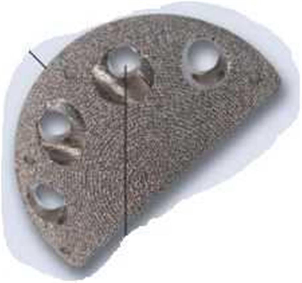 Produktbild - VF000131274 - ACETABULUM WEDGE AUGMENT 54 X 20MM