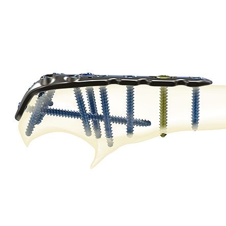 Produktbild - VF7002591 - Platta olecranon för ulna höger 81mm 3 hål